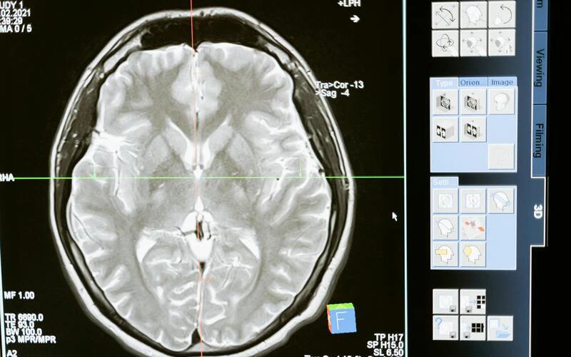 Trois ans d'IA en radiologie dans les CHU